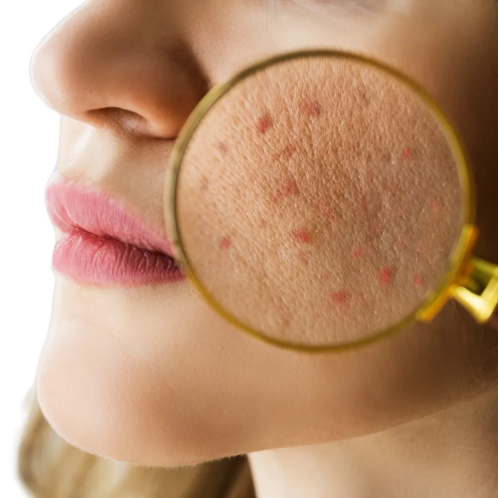 Acne – Aas Ayurveda