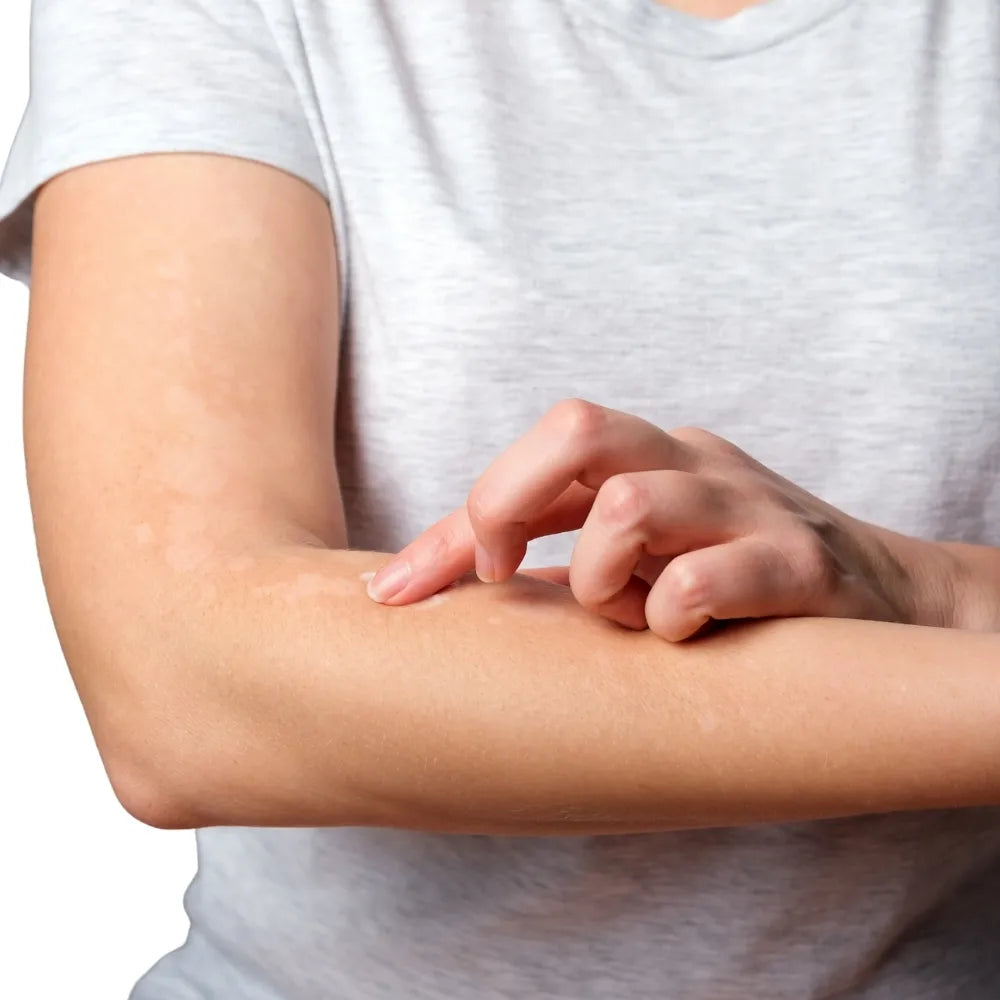 Allergic Dermatitis