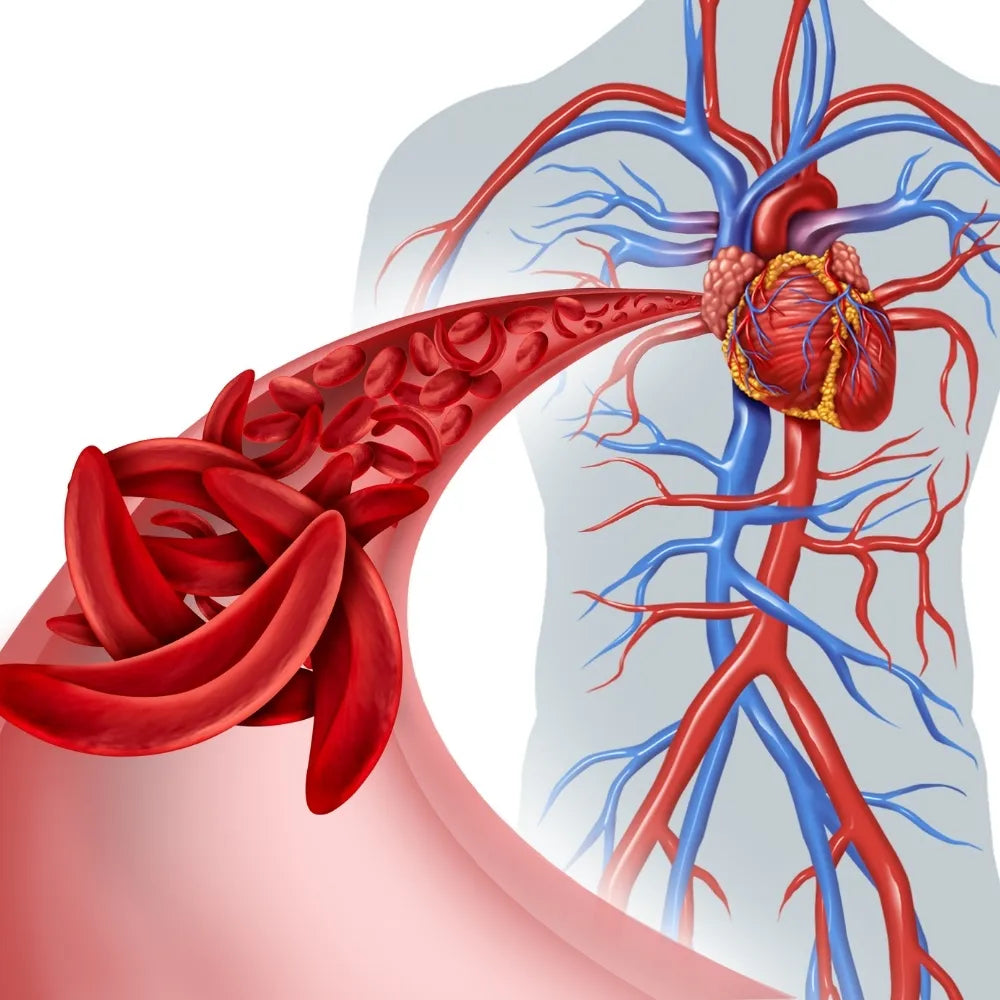 Anemia