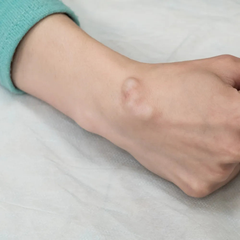 Benign Tumor
