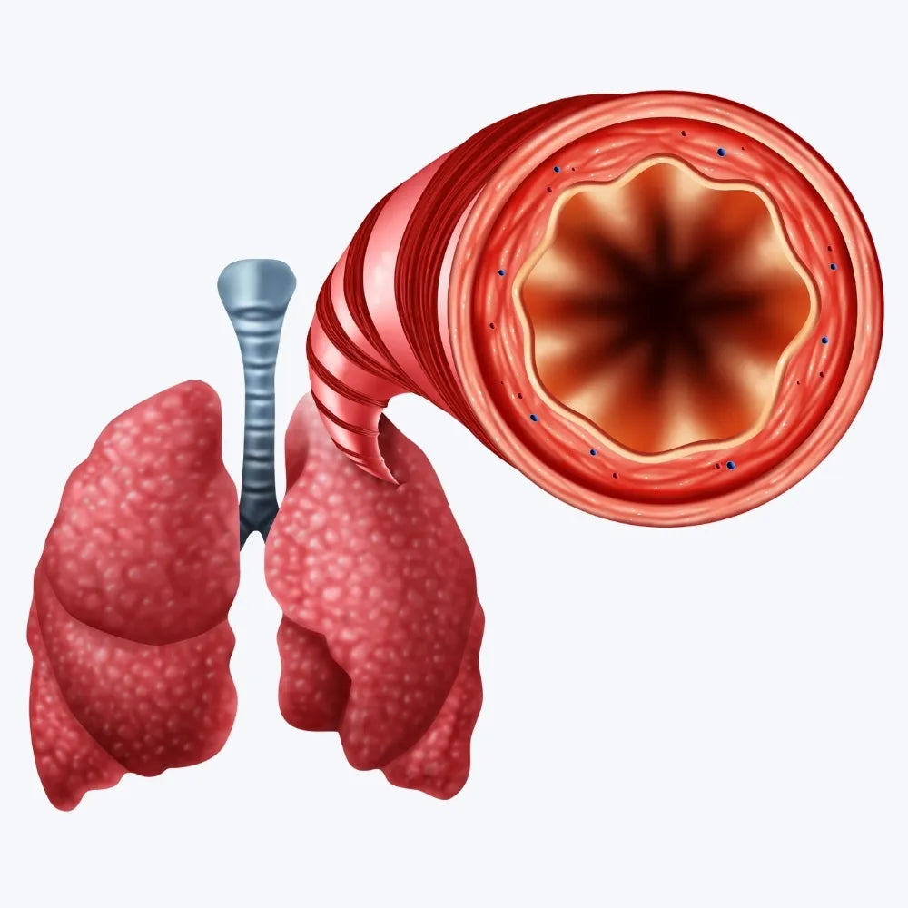 Bronchitis