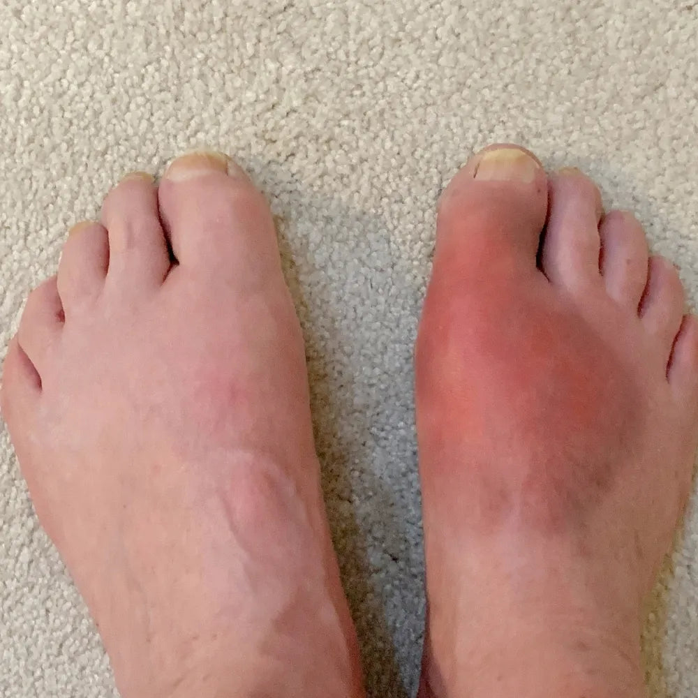 Gout