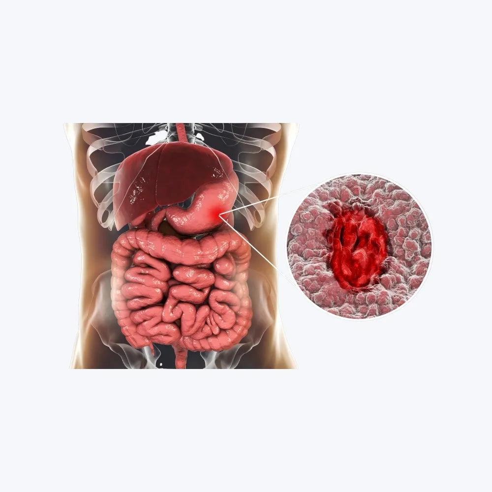 Ulcerative Colitis