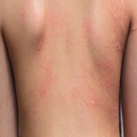 Allergic Dermatitis