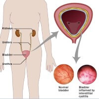 Cystitis