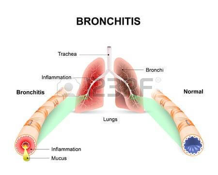 Allergic Bronchitis