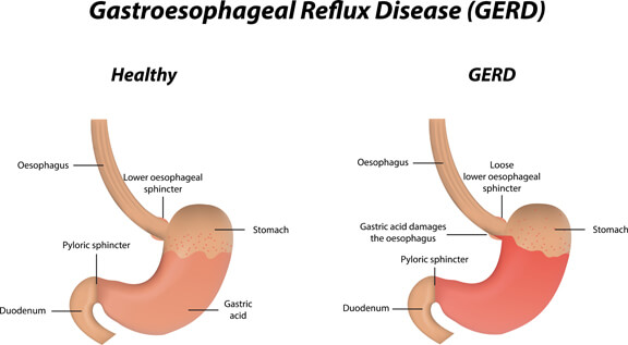 Effective Ayurvedic Treatment for GERD Get Relief Naturally