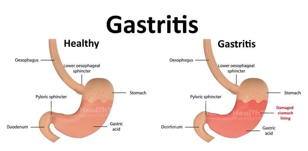 10-most-common-symptoms-of-gastritis-kienitvc-ac-ke