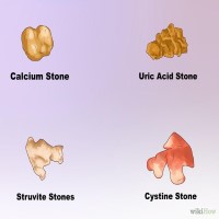 calcium oxalate kidney stones