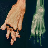 Rheumatoid Arthritis