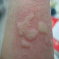 Urticaria Ayurvedic Treatment