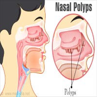 Nasal Polyps