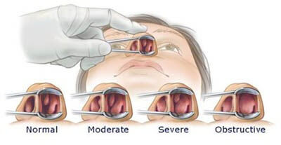 infected nasal polyp