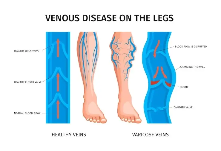 Varicose Veins Ayurvedic Treatment