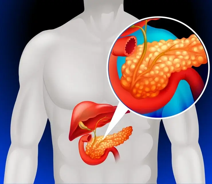 How To Gain Weight in Pancreatitis